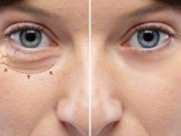 Upper and Lower Blepharoplasty (Eyelid Lift)
