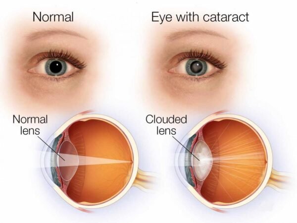 PHACOEMULSIFICATION & INTRAOCULAR LENS IMPLANTATION PROCEDURE FOR ONE EYE ONLY